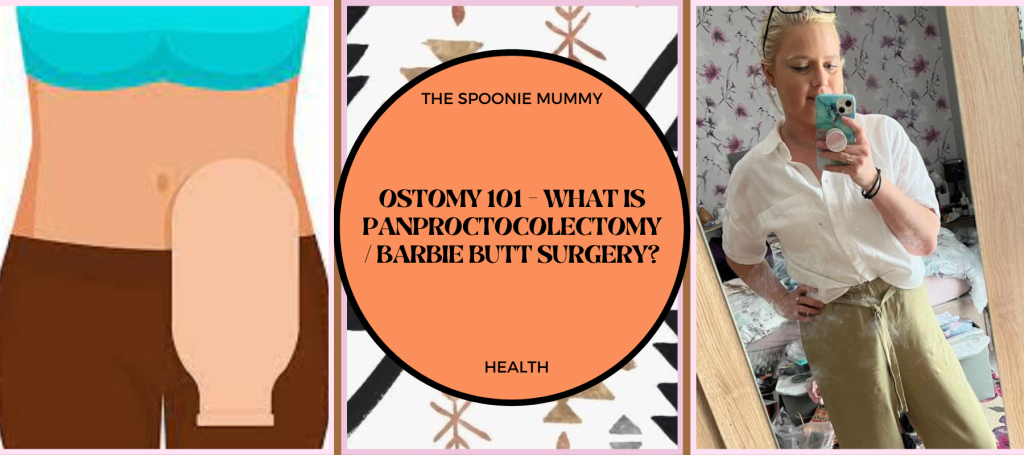 Ostomy 101 – What is Panproctocolectomy/Barbie Butt Surgery