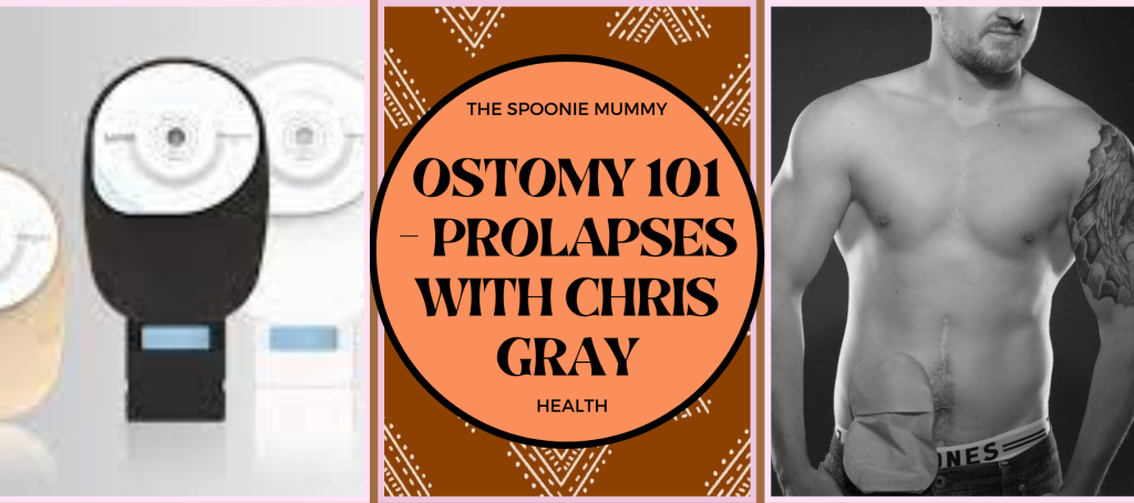 Ostomy 101 – Prolapses with Chris Gray